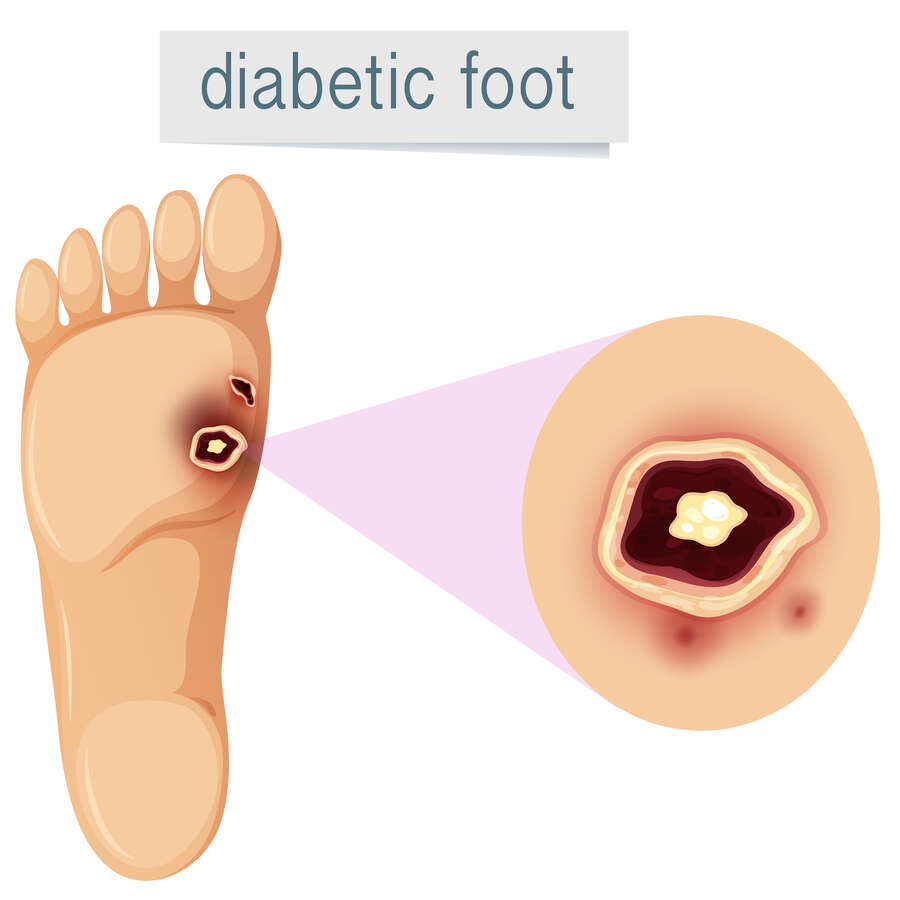 Le pied diabétique